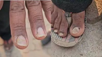 बाल झड़ने वाले मरीजों के सड़ने लगे हाथ-पैरों के नाखून, टेंशन में स्वास्थ्य विभाग