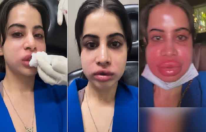Urfi Javed का बदला हुआ लुक देख हर कोई रह गया दंग, लिप फिलर्स हटवाने के बाद सूजे चेहरे का वीडियो हुआ वायरल Urfi Javed का बदला हुआ लुक देख हर कोई रह गया दंग